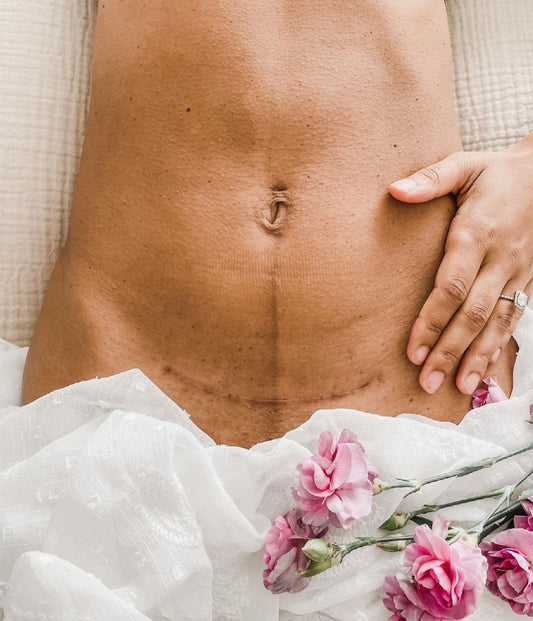 beautiful and empowering cesarean section scar on a new postpartum mother after birth